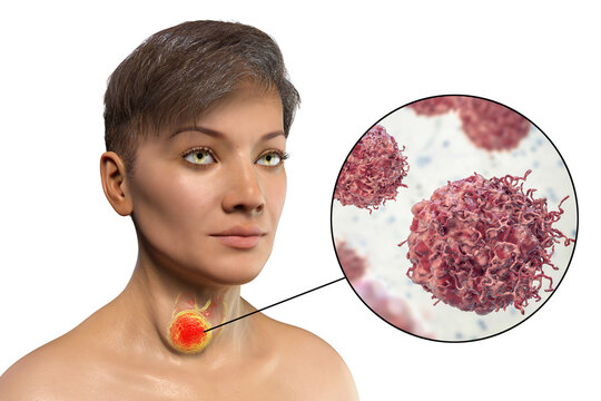 A 3D scientific illustration of a woman with thyroid cancer, and close-up view of thyroid cancer cells