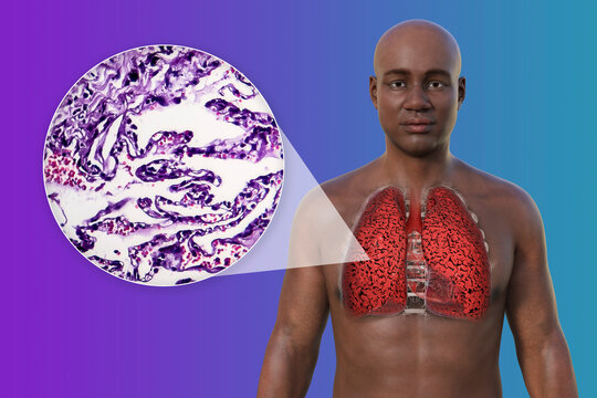 A 3D illustration of the upper half part of an African man with transparent skin, revealing the condition of smoker's lungs