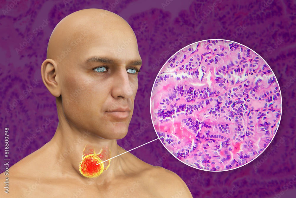 Sticker a 3d scientific illustration showcasing a man with transparent skin, revealing a tumor in his thyroi