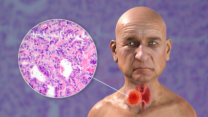 A 3D scientific illustration showcasing a man with transparent skin, revealing a tumor in his thyroid gland, along with a micrograph image of thyroid cancer.
