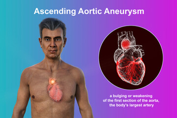 A 3D illustration of the upper half part of a senior man with transparent skin, revealing an ascending aortic aneurysm
