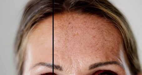 Woman Before And After Face Lift Therapy