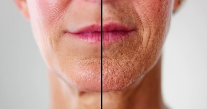 Woman Before And After Face Lift Therapy
