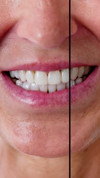 Female Teeth Between Before