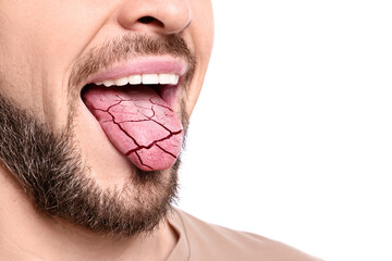 Dry mouth symptom. Man showing dehydrated tongue on white background, closeup