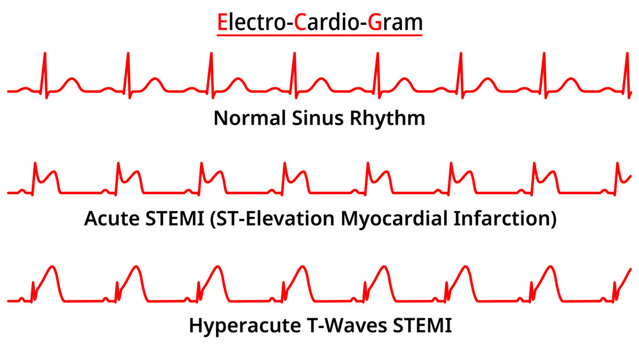 Set of ECG Common Abnormalities - Acute - Hyperacute STEMI (ST-Elevation Myocardial Infarction) - Normal Sinus Rhythm - Electrocardiography Vector Medical Illustration