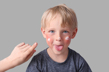 Mother applying cream onto her allergic little son's face on grey background, closeup