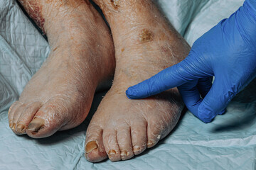 The skin on the legs of an elderly woman peels off due to eczema. Yellowing of the nail plate. Swelling of the legs. Consequences of diabetes in the elderly. Elderly care - obrazy, fototapety, plakaty