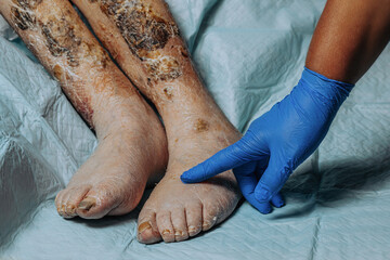 On the legs of an elderly woman, the skin peels off due to eczema, swelling of the legs. Yellowing of the nail plate. Swelling of the legs. Consequences of diabetes in the elderly. Elderly care