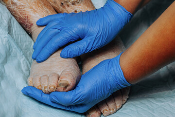 On the legs of an elderly woman, the skin peels off due to eczema, swelling of the legs. Yellowing...