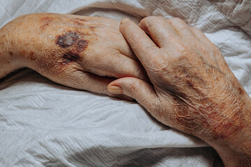 A bruise on the hand of an elderly person. Known as senile purpura. Caused by the fragility of the...