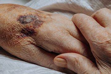 Naklejka premium A bruise on the hand of an elderly person. Known as senile purpura. Caused by the fragility of the skin and blood vessels in old age. Elderly care