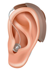 Hearing aid. Sound amplifier for patients with hearing loss. Medicine and health. Realistic object behind the ear. Treatment and prosthetics in otolaryngology