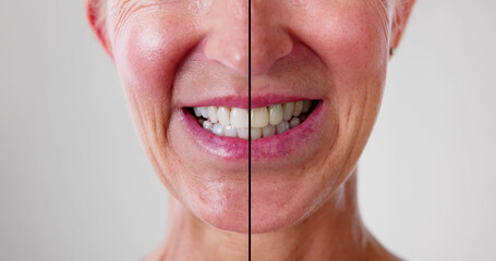 Female Teeth Between Before
