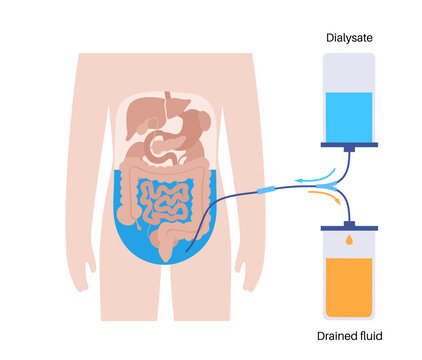 Peritoneal dialysis concept
