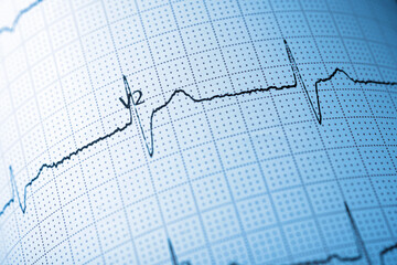 Close-up of an electrocardiogram printed on blue paper.
