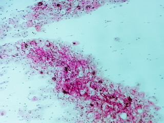 Paps smear: Inflammatory smear with HPV related changes. Cervical cancer. SCC