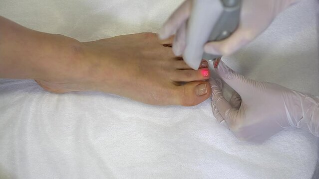 Top view woman doctor doing laser treatment procedure for toenail fungus. Fungal infection on the nails. Treatment of onychomycosis with a medical laser