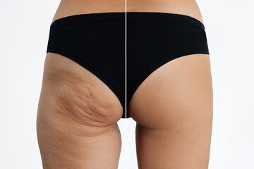 Young tanned woman's buttocks with cellulite before after treatment and sports isolated on a white background. Getting rid of excess weight. Result of diet, massage, sports. Improving skin on thighs - obrazy, fototapety, plakaty