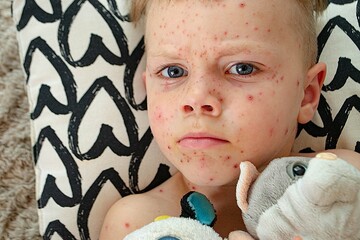 Natural vaccination. Contagious disease.