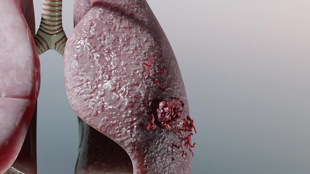 Pneumonia illness, healthy lungs and disease lungs, Human Lungs cancer, Cigarette smokers Lung disease, cancerous malignant tumor growing and spreading, respiratory system, asthma infection, 3d render
