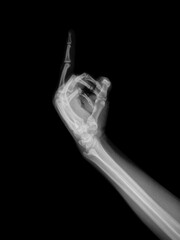 x ray of hand