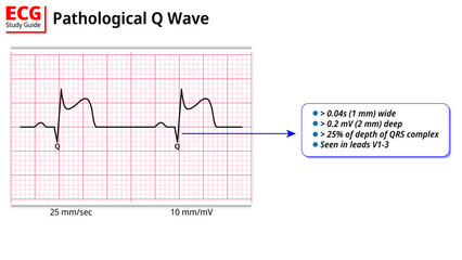 Pathological Q Waves Criteria - ECG Education with Study Guide - Electrocardiography Vector Medical Illustration