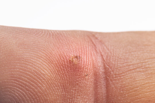 Finger with infection from wood splinter