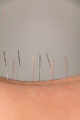 Close up of a needle of acupuncture