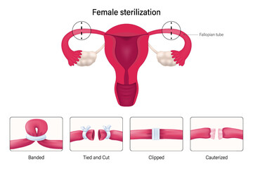 Female sterilization, Tubal ligation procedures vector. Banded, Tied and cut, Clipped and Cauterized. 