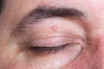 Papillomas or warts on eyelid and nose on man's face. Human papilloma virus (HPV). 