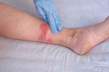 doctor treats large healing wound from on lower leg with scars of adult female patient, redness,...