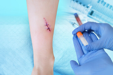 fresh wound on child's leg, wound care in hospital, non-absorbable sutures on the skin, trauma...