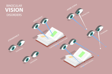 3D Isometric Flat Vector Conceptual Illustration of Binocular Vision Disorders, Medical Sight Health Problems