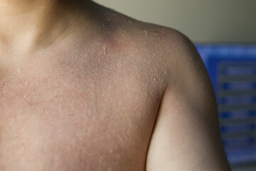Man sunburn skin damage peeled off after exposure sun burn