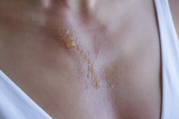Fototapeta premium A second-degree burn with blister on woman's chest