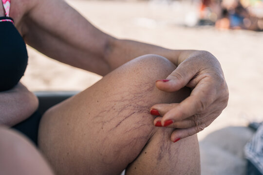 Legs with varicose veins of an elderly person sitting on the beach. Close-up image of an elderly woman on vacation sitting in her beach chair.
