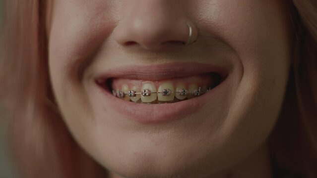 Smiling Mouth with Dental Braces Close Up. Young female half face smile.