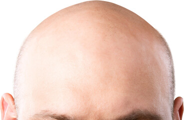 Fototapeta premium Methods of hair transplantation. Human alopecia or hair loss problem on adult senior or mature man.