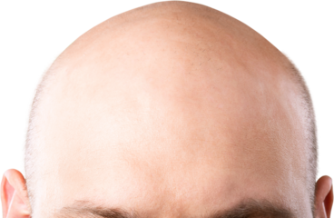 Methods of hair transplantation. Human alopecia or hair loss problem on adult senior or mature man.