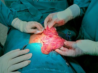 Surgeon performing excision of Lipoma under aseptic precaution