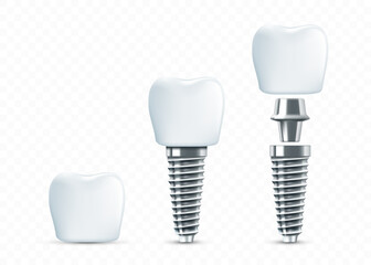 Dental implant scheme. Template isolated on transparent background. vector mockup
