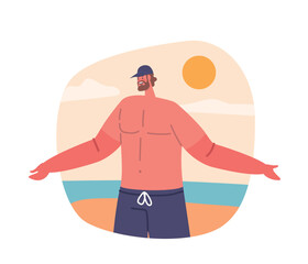 Man With Sunburned Hands, Red And Peeling From Prolonged Sun Exposure. A Painful Reminder Of The Importance