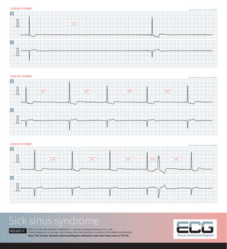 An 81 year old elderly male was clinically diagnosed with coronary heart disease and cerebral vascular insufficiency. The dynamic electrocardiogram indicated sick sinus syndrome.