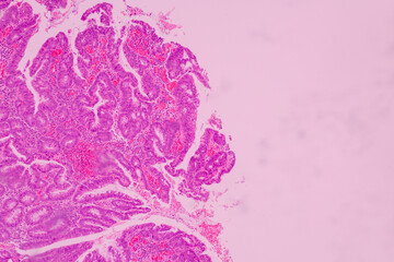 Backgrounds of human cells tissue of lung human under the microscope in pathology lab.View in microscopic of ductal cell carcinoma, adenonocarcinoma from human breast cancer, tissue section by H and E - obrazy, fototapety, plakaty
