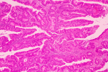 Backgrounds of human cells tissue of lung human under the microscope in pathology lab.View in microscopic of ductal cell carcinoma, adenonocarcinoma from human breast cancer, tissue section by H and E - obrazy, fototapety, plakaty