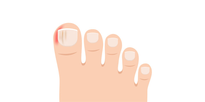Swollen toe cartoon vector. Person feet with nail disease or infection. Foot with onychomycosis or fungus on fingers