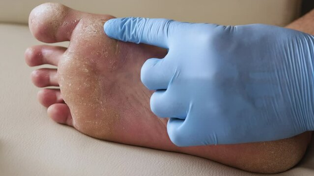 Dry skin, Foot psoriasis The skin is damaged. Dermatitis, eczema, psoriasis, allergic reactions. Diagnosis of peeling and cracks on the human leg. Fungal infection or athlete's foot, sweaty feet.