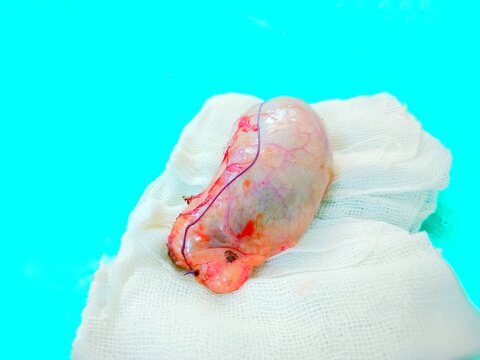 Acute cholecystitis S/P Cholecystectomy, Gallbladder