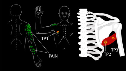 Teres major muscle. Trigger points and referred pain in the arm and shoulder